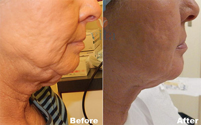 VITA SURGICAL MINI FACELIFT BEFORE AFTER PHOTO