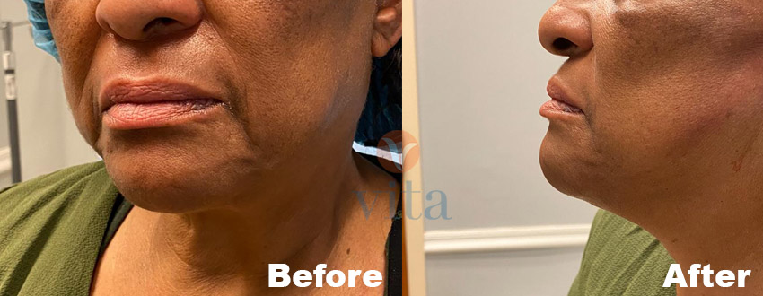 VITA SURGICAL MINI FACELIFT BEFORE AFTER PHOTO