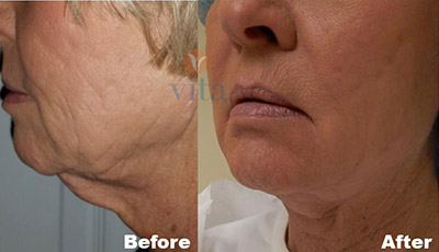 VITA SURGICAL MINI FACELIFT BEFORE AFTER PHOTO