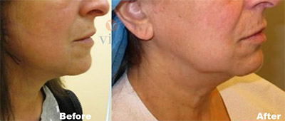 VITA SURGICAL MINI FACELIFT BEFORE AFTER PHOTO