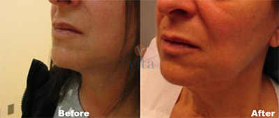 VITA SURGICAL MINI FACELIFT BEFORE AFTER PHOTO