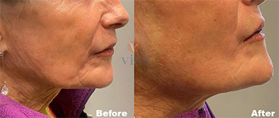 VITA SURGICAL MINI FACELIFT BEFORE AFTER PHOTO