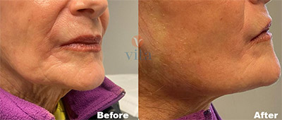 VITA SURGICAL MINI FACELIFT BEFORE AFTER PHOTO