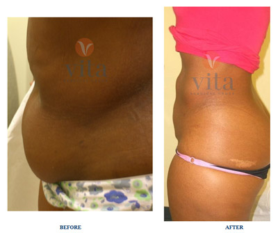 VITA SURGICAL LIPOSUCTION BEFORE AFTER PHOTO