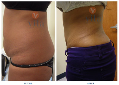 VITA SURGICAL LIPOSUCTION BEFORE AFTER PHOTO
